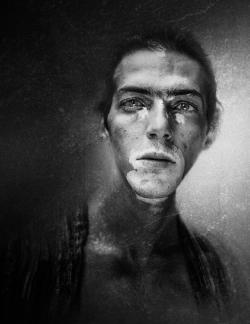 Vitiligo young man